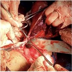 Figure 4. Intraoperative image showing the uterus and placenta removed en bloc, with clear visualization of the cervix