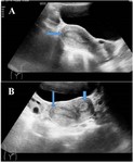 Figure 1A. A 21-year-old nulligravida presenting with pain in the left iliac fossa. USG (A) sagittal image shows a normal uterus (arrow) and (B) axial image shows a normal uterus with echogenic endometrium (long arrow) and ACUM in the left lateral wall of the uterus (short arrow)