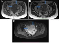Figure 1B. MRI axial images: (A) T1-weighted, (B) T2-weighted, and (C) post -contrast T1 fat-saturated sequences show the uterus (horizontal arrow) and ACUM (vertical arrow). The lesion shows hyperintense contents on both T1- and T2-weighted images, consistent with blood products