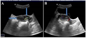 Figure 2A. A 20-year-old nulligravida presenting with chronic pelvic pain and dysmenorrhea. USG (A) axial image shows normal uterine cavity (horizontal arrow) and ACUM in the left lateral wall of the uterus, showing fluid in the accessory cavity (vertical arrow) and (B) left parasagittal image shows ACUM and peripheral vascular flow