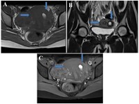 Figure 2B. MRI images: (A) axial T1-weighted image shows uterus (horizontal arrow) and hyperintense cavity of ACUM (vertical arrow) suggestive of blood products, (B) coronal T2-weighted image shows uterus (horizontal arrow) and ACUM (vertical arrow) with a hyperintense signal in accessory cavity, and (C) axial post-contrast T1 fat-saturated image shows normal enhancement of uterine myometrium (horizontal arrow) and normally enhancing myometrium surrounding cavity of ACUM (vertical arrow)