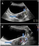 Figure 3A. A 32 -year- old multiparous presenting with recurrent left lower abdominal pain. (A) Axial grayscale image and (B) color Doppler image show the uterus (horizontal arrow) and ACUM (vertical arrow) with peripheral vascular flow in the left lateral wall of the uterus