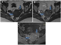 Figure 3B. MRI axial images: (A) T1-weighted; (B) T2-weighted; and (C) post- contrast T1 fat-saturated images show uterus (horizontal arrow) and ACUM (vertical arrow) in left lateral uterine wall, having hyperintense signals on both T1- and T2-weighted images, consistent with hemorrhagic contents