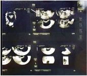 Figure 1. A 7&times;3 cm multiloculated cystic lesion located lateral to the left ovary, suggestive of hydrosalpinx