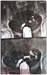 Figure 2. Hysterosalpingography revealing a left-sided hydrosalpinx with complete tubal occlusion