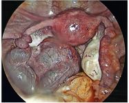 Figure 3. Laparoscopic view showing a twisted left fallopian tube suggestive of tubal torsion