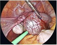 Figure 4. Laparoscopic view showing a twisted left-sided hydrosalpinx