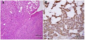 Figure 1. Histopathological features of appendiceal neuroendocrine tumors (Case 1); (A) H&amp;E-stained section showing the neuroendocrine tumor with invasion into the mesoappendix and (B) immunohistochemistry staining for chromo-granin, confirming neuroendocrine tumor