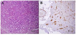 Figure 2. Histopathological features of appendiceal neuroendocrine tumor (Case 2); (A) H&amp;E-stained section showing the neuroendocrine tumor with invasion into the muscularis propria and (B) synaptophysin staining highlighting neuroendocrine differentiation