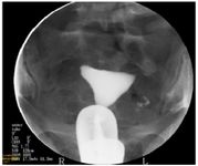 Figure 1. HSG demonstrating right proximal tubal occlusion with no intraperitoneal spillage of contrast medium. The left tube is patent with delayed contrast escape. The uterine cavity appears normal