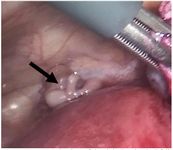 Figure 2. Laparoscopic view of the right intraluminal fallopian tube mass