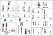 Figure 1. Images representing different chromosomal variants identified in men experiencing infertility. A: balanced Robertsonian translocation; B: balanced Robertsonian translocation; C: balanced reciprocal translocation; D: balanced reciprocal translocation; E: deletion on long arm (q) of chromosome Y; F: a mosaic karyotype exhibiting both a normal cell line and a cell line with a deletion on the long arm (q) of chromosome Y; G: mosaic karyotype with loss of chromosome Y and deletion of long arm (q) of chromosome Y; H: 47,XXY/48,XXXY; I: 47,XYY; J: 47,XXY