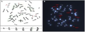 Figure 2. A) representative karyotype illustrating a chromosomal variant on the NOR region of the short p-arm of an acrocentric chromosome and B) karyotype representation illustrating a chromosomal heteromorphic variant region on the long q-arm of a non-acrocentric chromosome, utilizing inverted DAPI staining