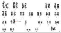 Figure 1. Karyotype of the female with 45, XX, rob (14;15) (q10;q10) chromosomal constitution