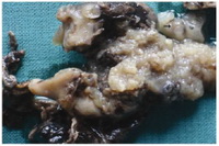 Figure 1. Ruptured tube showing fetus and placental tissue with molar changes