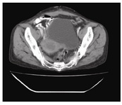 Figure 1. Post-operative contrast enhanced computerized tomography showing advanced carcinoma cervix

