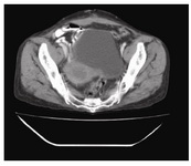 Figure 1. Post-operative contrast enhanced computerized tomography showing advanced carcinoma cervix

