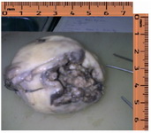 Figure 1. Post operative specimen of uterus showing large fundal defect