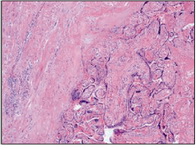 Figure 2. Histopathological image of uterine tissue showing chorionic villi invading myometrium and absence of decidua basalis.