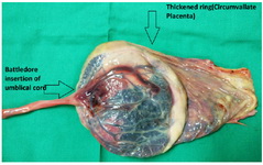 Figure 1. Coexistent Battledore insertion of umbilical cord and circumvallate placenta