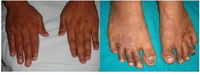 Figure 2. Shedding of hand and feet nails in 4 weeks