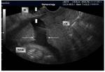 Figure 1. Transvaginal ultrasound examination in the 24th week of gestation demonstrated a 17 mm fenestration within the uterine scar (Large arrow). Thinning of the myometrium over the cesarean scar defect is seen behind the bladder (Small arrow)