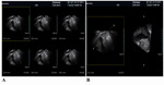 Figure 2. A and B: Multislice and three-dimensional ultrasound image (coronal view) in the 24th week of gestation showing the fenestration with a 17 mm diameter