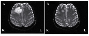 Figure 2. Magnetic resonance images of the brain abscess. Both images are taken by diffusion weighed imaging. A: Axial image at 22ne week of pregnancy shows the large right frontal abscess with severe edema. B: Axial image at 28th week of pregnancy shows no enlargement of the abscess and disappearance of the surrounding edema