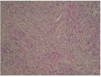 Figure 2. Pathologic feature of the tumor in a 24 year old patient, December 2012, Rasoul-e-Akram hospital, Tehran, Iran