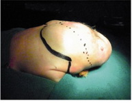 Figure 1. Showing lateral view of the baby with Type II Sacrococcygeal teratoma in Prone Jack Knife position. Tumor is marked with solid line and the incision with dotted line