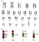 Figure 1. The chromosomes involved in the translocation t(18;22)(q21.1;q12) of the illustrated case. A. The GTG banded karyogram showing the translocation breakpoint regions. B. The partial  ideogram showing normal chromosome 18 in red and normal 22 in green and both derivative 18 and derivative 22 in red and green
