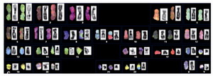 Figure 2. SKY on the lymphocyte metaphase showing the representative karyotypes illustrating the display colours on the left and the classification colours on the right. In the center, there are the DAPI band images