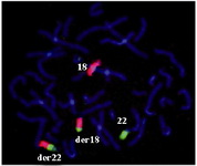 Figure 3. WCP FISH on the metaphase spreads of the proband.  The normal chromosome 18 is in red and the normal 22 in green.  Derivative 18 and derivative 22 are shown both in red and green