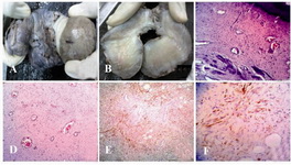 Figure 1. A: Excised polypoidal growth; B: Cut surface was solid, grey brown without any areas of hemorrhage or necrosis; C: Section showing unremarkable stratified squamous epithelium and tumour comprised of spindle and stellate shaped cells with many prominent blood vessels (hematoxylin and eosin stain, 100x); D: Section showing spindle and stellate shaped tumour cells with many prominent blood vessels in a myxoid stroma (hematoxylin and eosin stain, 100x); E: Vimentin positivity in tumour cells; F: Focal desmin positivity in tumour cells