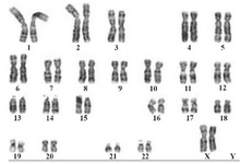 Figure 1. The Karyotype shows the patient is having two X chromosome and no Y chromosome