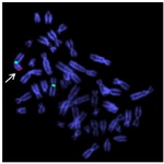 Figure 3. Dual color FISH data shows presence of two X chromosomes and SRY gene on one of the X chromosome