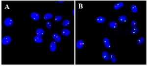 Figure 1. Sperm Aneuploidy by FISH. A: The picture showing the normal signal pattern of chromosome 13 (green) and 21 (red) on sperms. B: Normal signal pattern of chromosome X (green), Y (red) and 18 (Aqua) on sperm