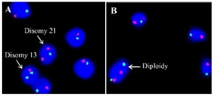 Figure 2. Sperm Aneuploidy by FISH. A: Sperm FISH picture showing disomy for chromosomes 13 (green) and 21 (red). B: FISH picture showing diploidy for chromosomes 13 and 21
