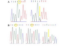 Figure 2. A: The graph of sequencing results for rs12470652. B: The graph of sequencing results for rs2293275