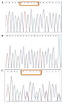 Figure 4. Direct sequencing of exon 1. A: homozygote for the 6bp insertion, B: homozygote without the insertion, C: heterozygote for the 6bp insertion