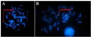 Figure 3. Image showing the Fluorescent in Situ Hybridization on metaphase of proband -45 XY, t (4;7) (q27;p22) rob (13;14) (q10;q10). A) Metaphase image showing the translocation of chromosome 13 and 14, B) Metaphase image showing the breakpoint on chromosome 4 q27
