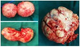 Figure 1. Different myomas; A: 3 cm, B: 8 cm, D: 18 cm