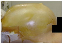 Figure 1. Preoperative appearance of the abdominal distension
