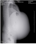 Figure 2. Scout view of the abdominopelvic mass