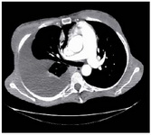 Figure 3. Thoracic axial CT-scan showing a right pleural effusion