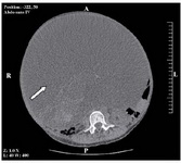 Figure 4. Abdominal axial CT-scan showing a voluminous ovarian cyst (white arrow)