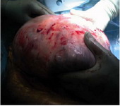 Figure 5. Extraction of the abdominopelvic mass