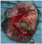 Figure 6. Macroscopic view of the ovarian tumor