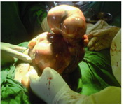 Figure 2. Intra-operative picture of the uterus delivered through the incision site before the removal of the fibroid masses