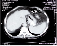 Figure 2. Cirrhosis was revealed by abdominal CT scan